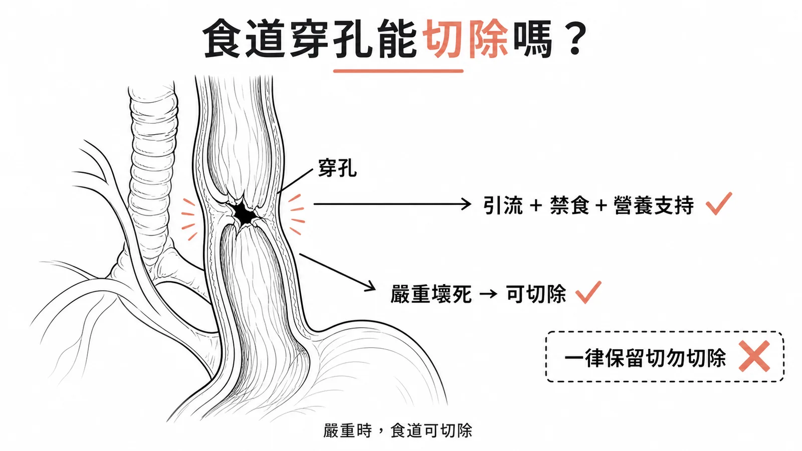 食道穿孔治療原則包含必要時切除食道