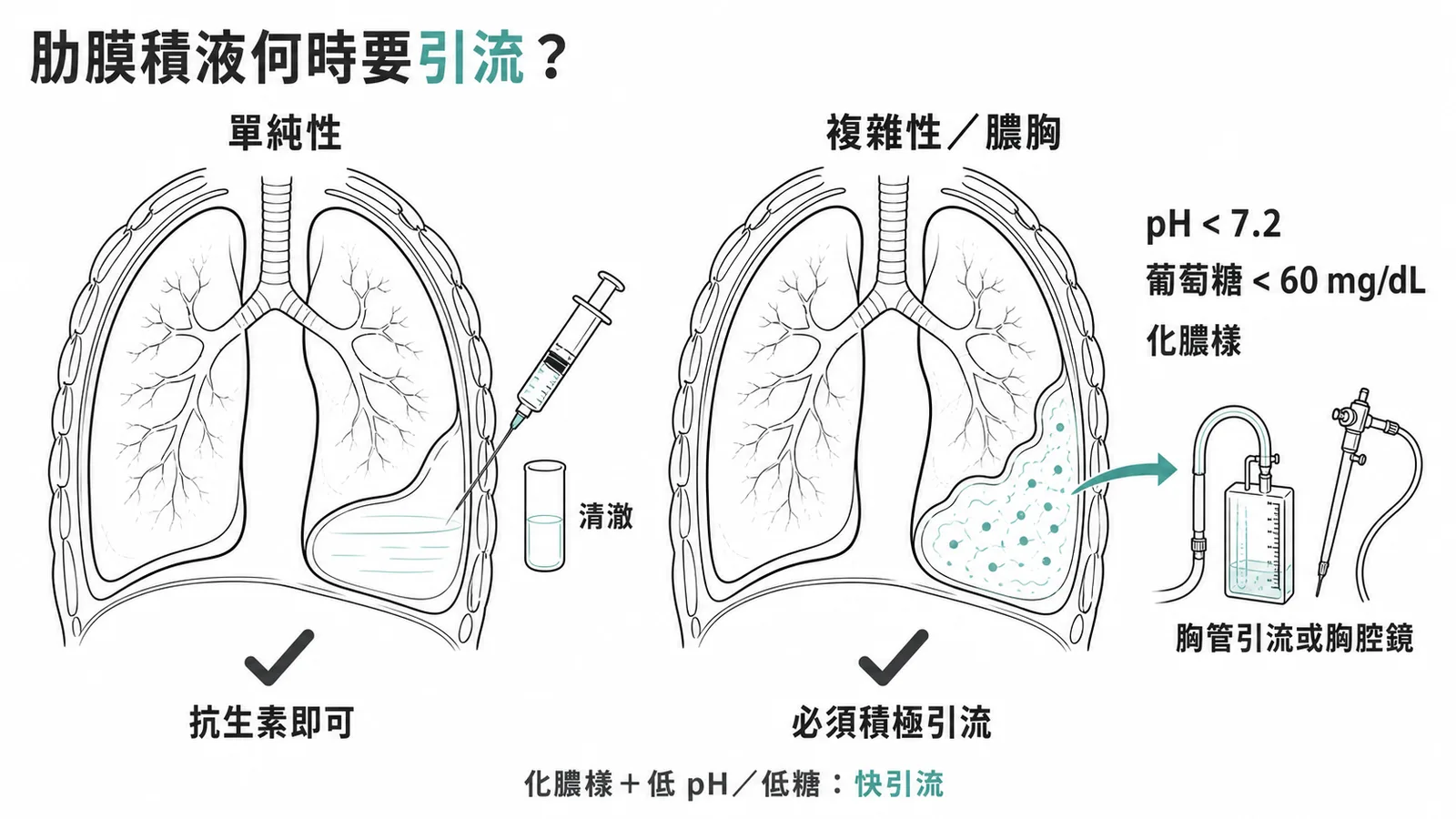 複雜性肋膜積液判定標準與需積極引流