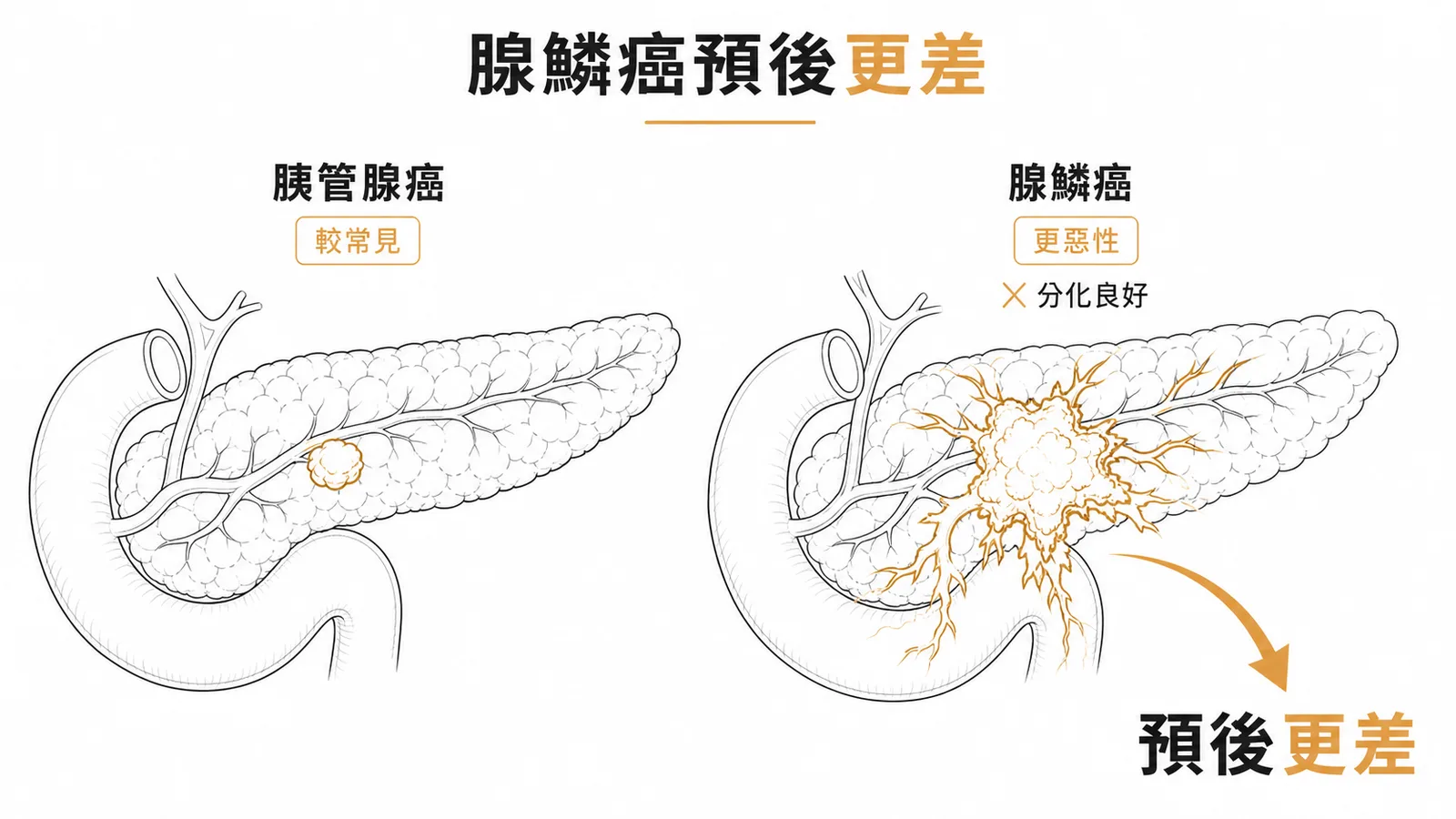 腺鱗癌比胰管腺癌分化更差、預後更差