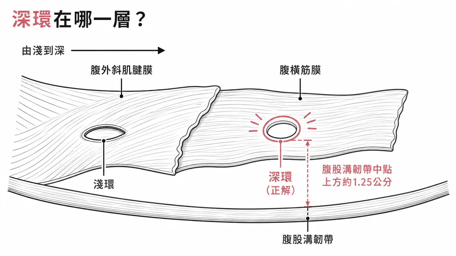 腹股溝深環位於腹橫筋膜的開口