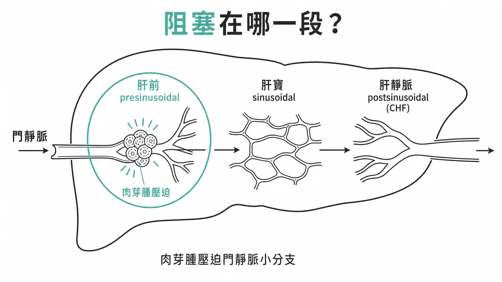 結節病肉芽腫壓迫門靜脈分支屬肝竇前門脈高壓