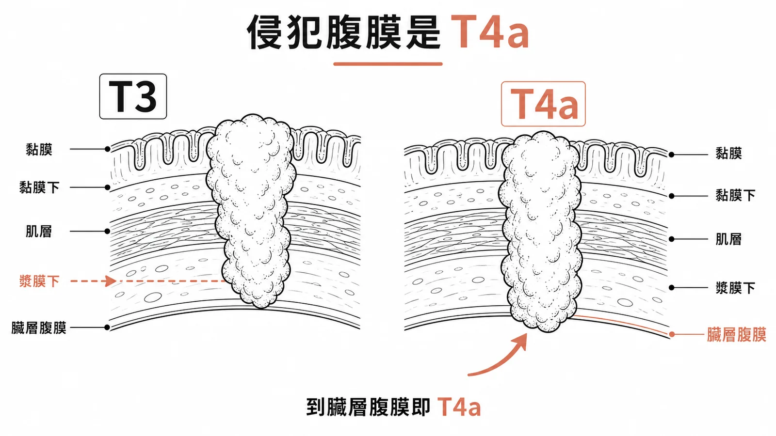 侵犯臟層腹膜為T4a而非T3