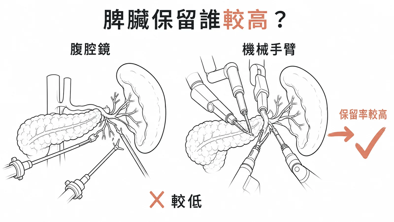 機械手臂遠端胰切的脾臟保留率較高