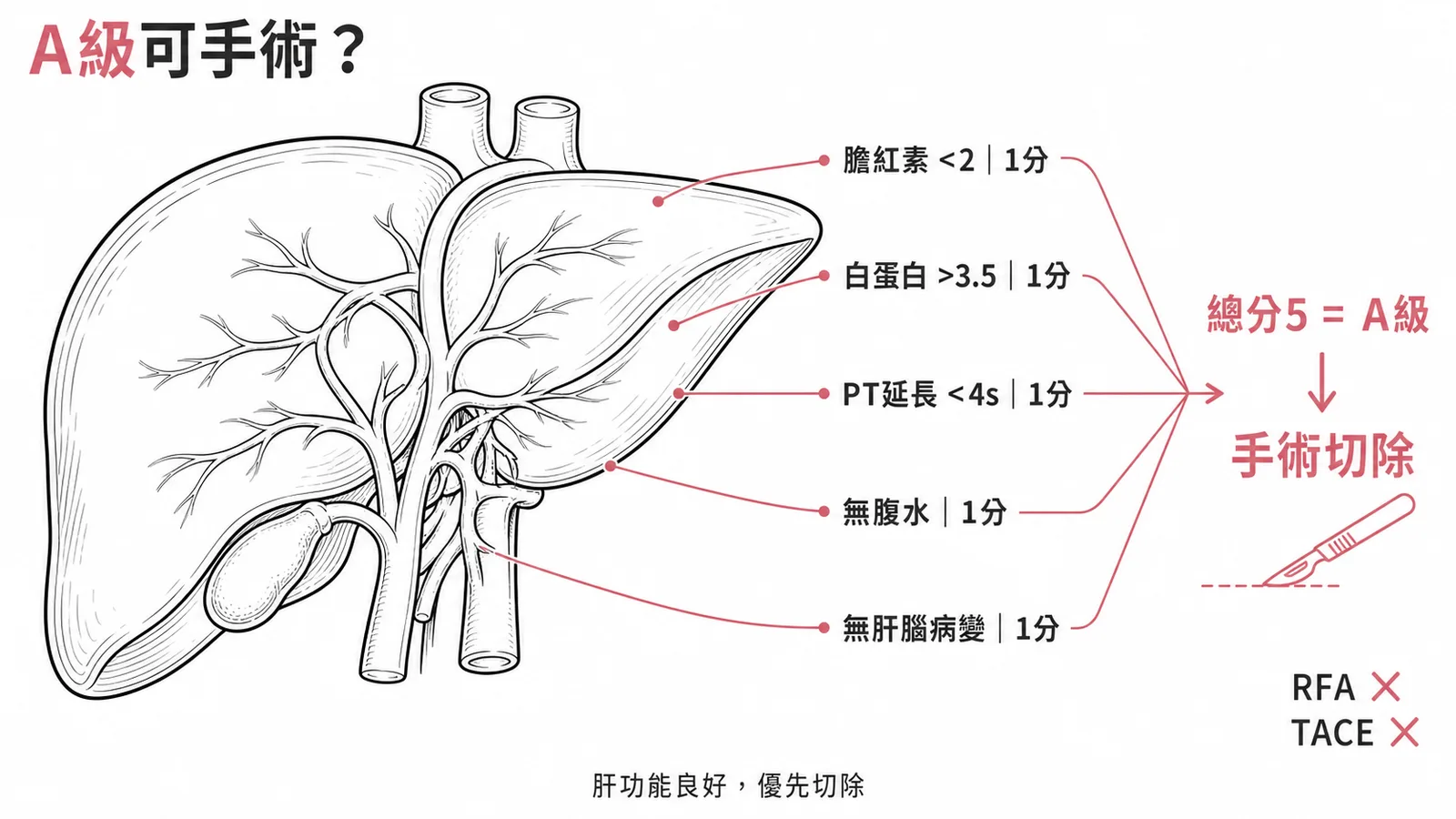 Child-Pugh 五項指標計分示意圖,總分 5 分屬 A 級,肝功能良好適合手術切除