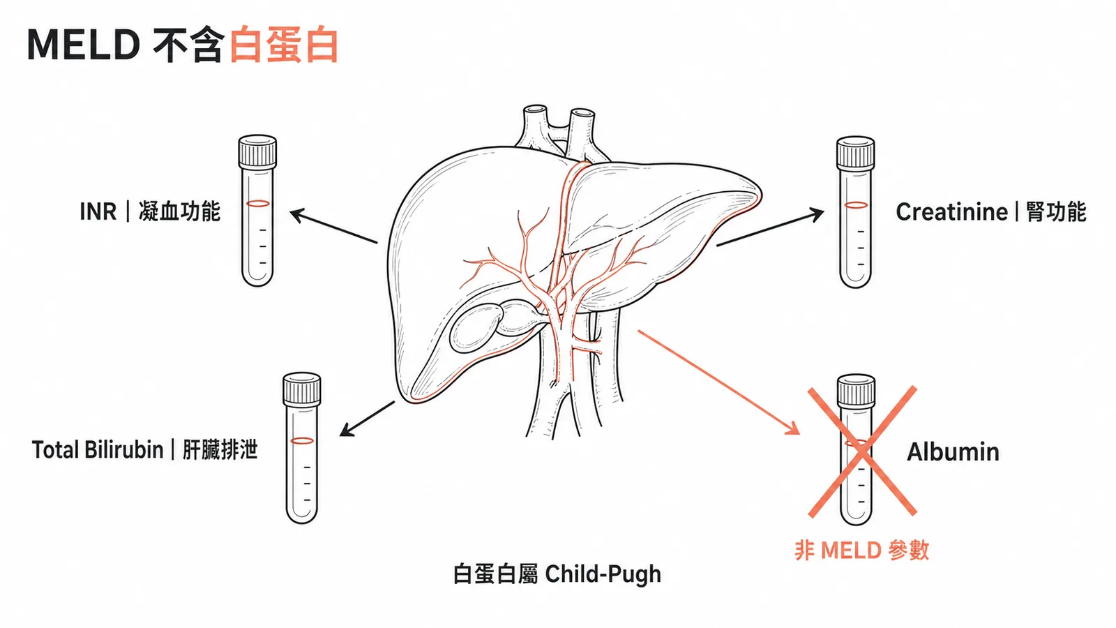 MELD score 三大參數示意圖:INR、Creatinine、Bilirubin,Albumin 打叉非 MELD 而是 Child-Pugh