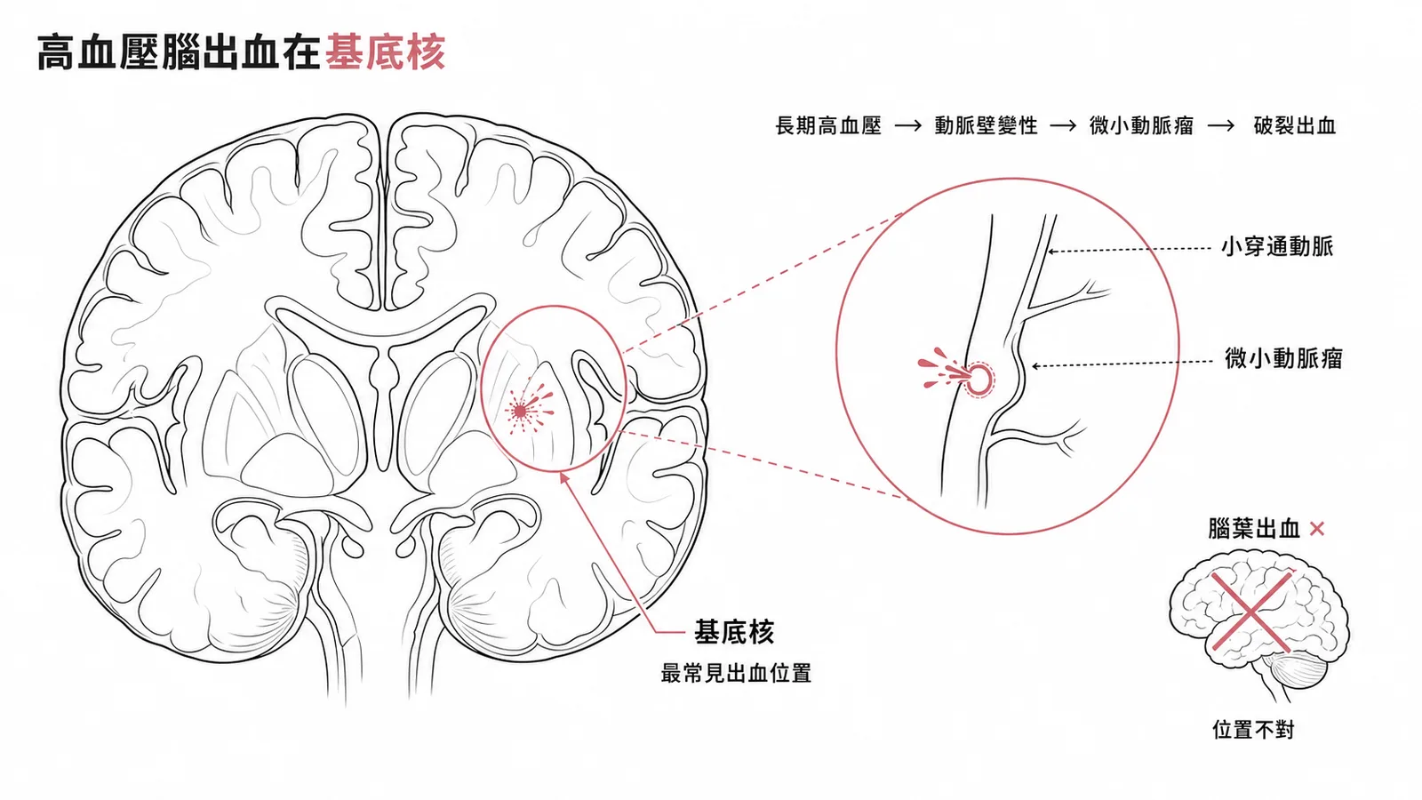 高血壓致基底核出血機轉示意圖,小穿通動脈形成 Charcot-Bouchard 微小動脈瘤破裂