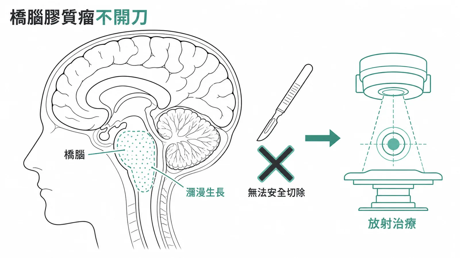 瀰漫性橋腦膠質瘤不宜手術切除示意圖,瀰漫生長於腦幹關鍵位置,主要用放射治療