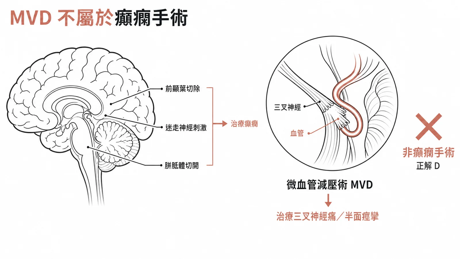 癲癇手術 vs 微血管減壓術對照圖,MVD 用於三叉神經痛非癲癇,打叉標示