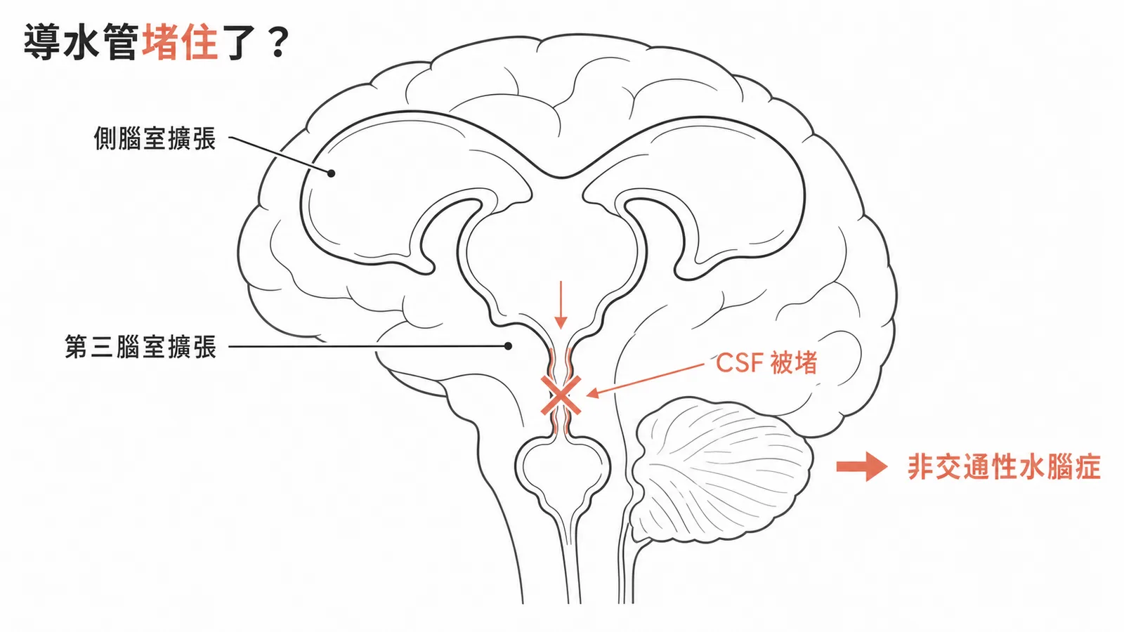導水管狹窄屬於非交通性水腦症示意圖
