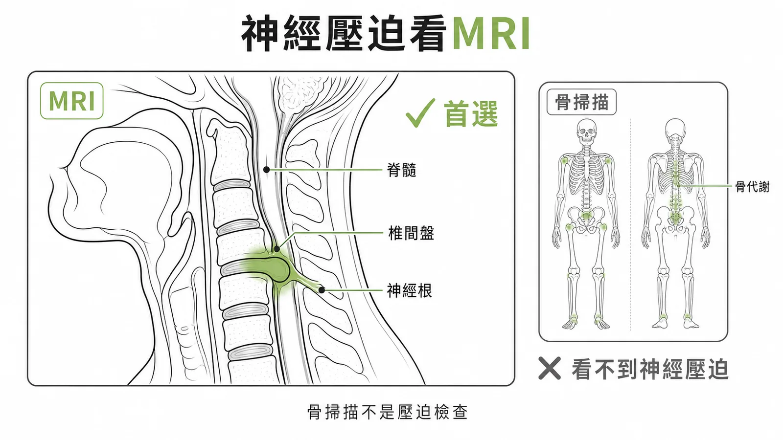 MRI是診斷頸椎神經壓迫的首選影像工具