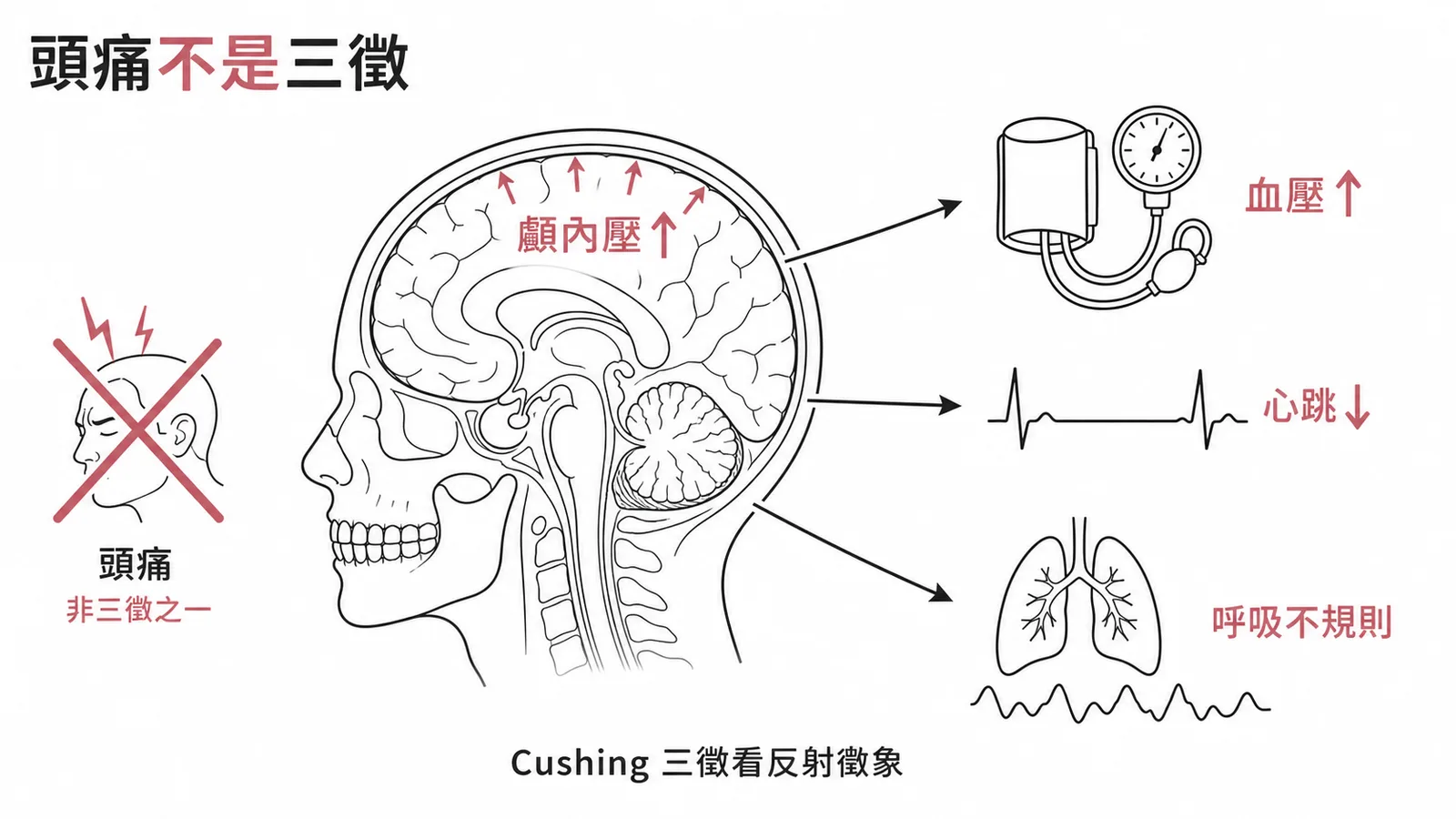 Cushing三徵:高血壓、心搏過緩、呼吸不規則