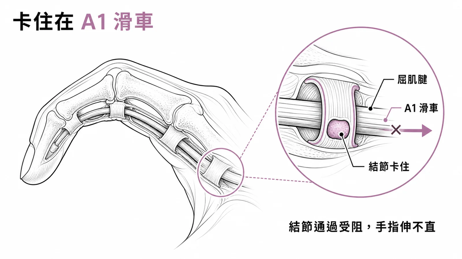 板機指是屈肌腱卡在A1滑車處