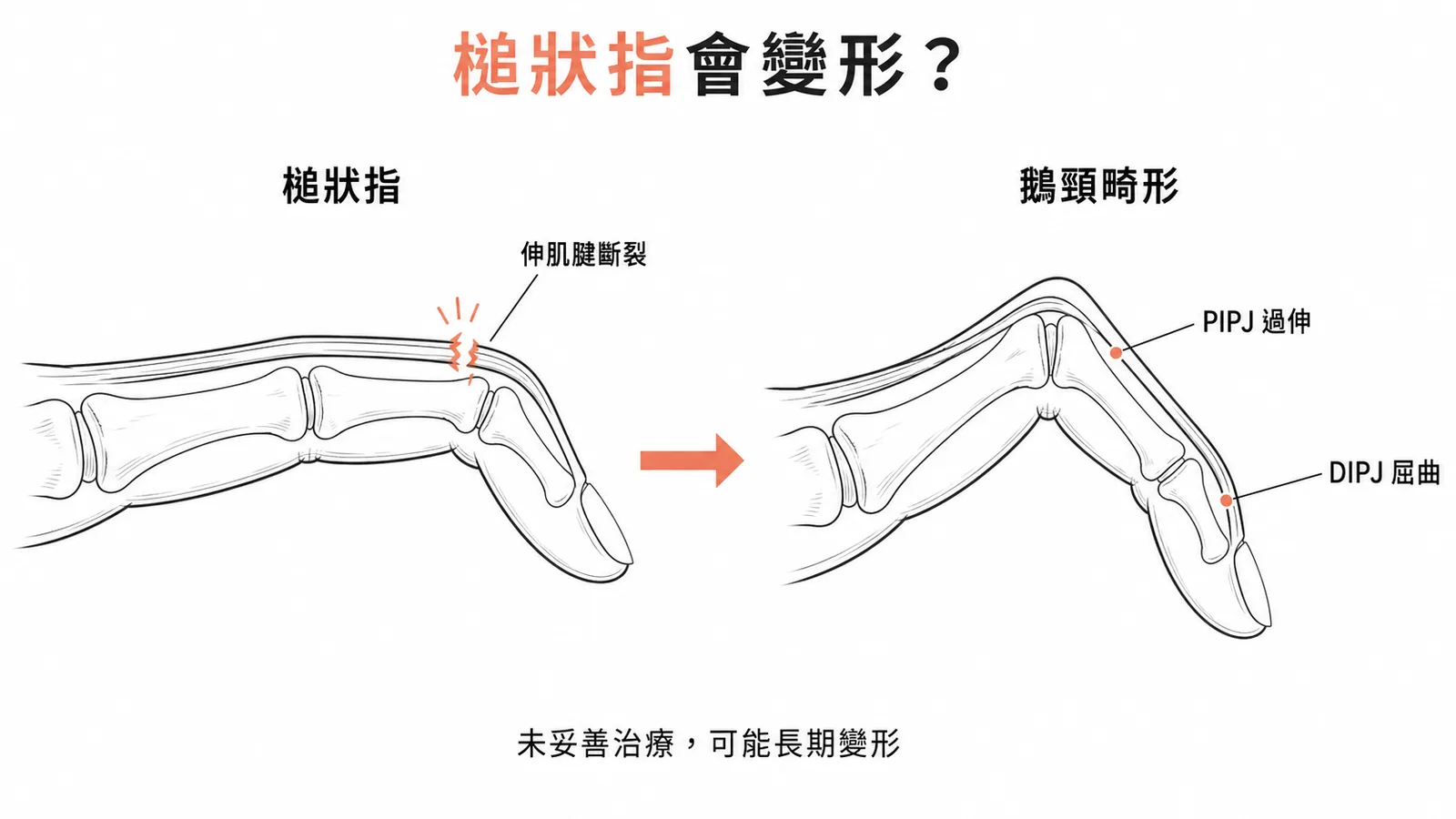 槌狀指未治療可演變為鵝頸畸形