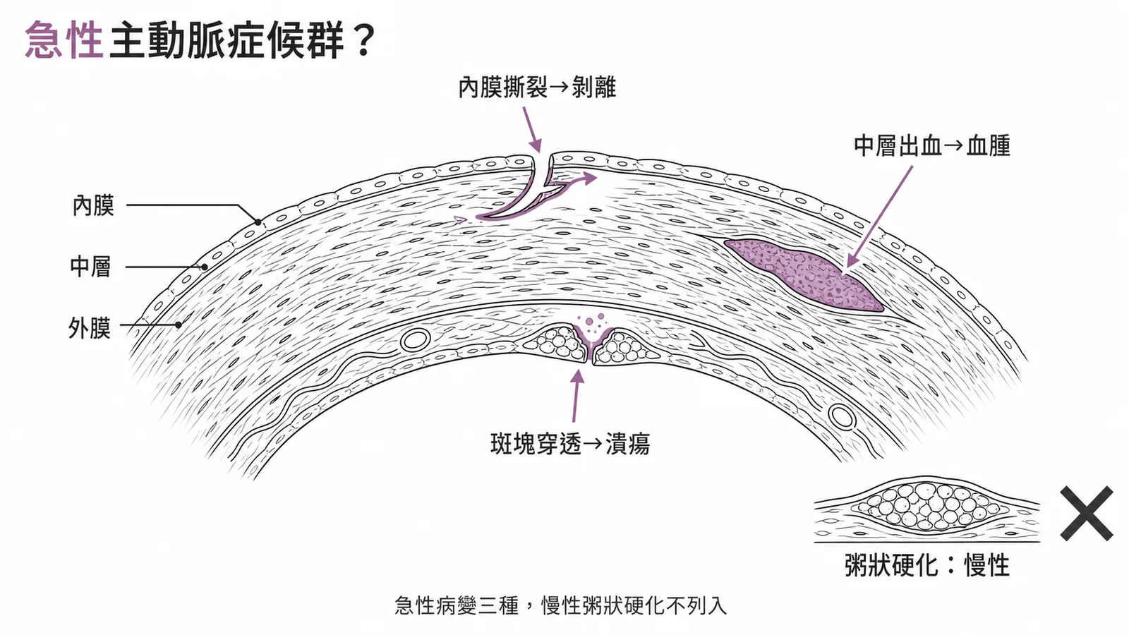 急性主動脈綜合症三大類型示意圖