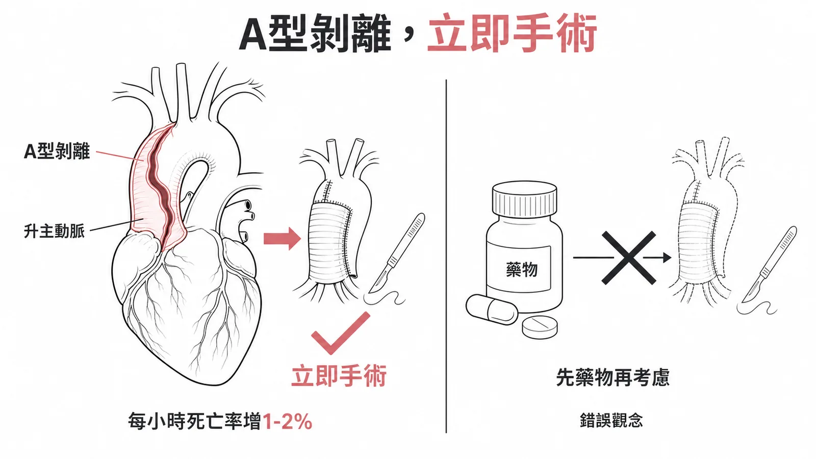 急性A型主動脈剝離須立即手術治療