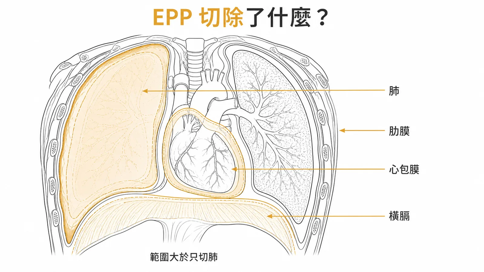 肋膜外全肺切除術切除範圍示意圖
