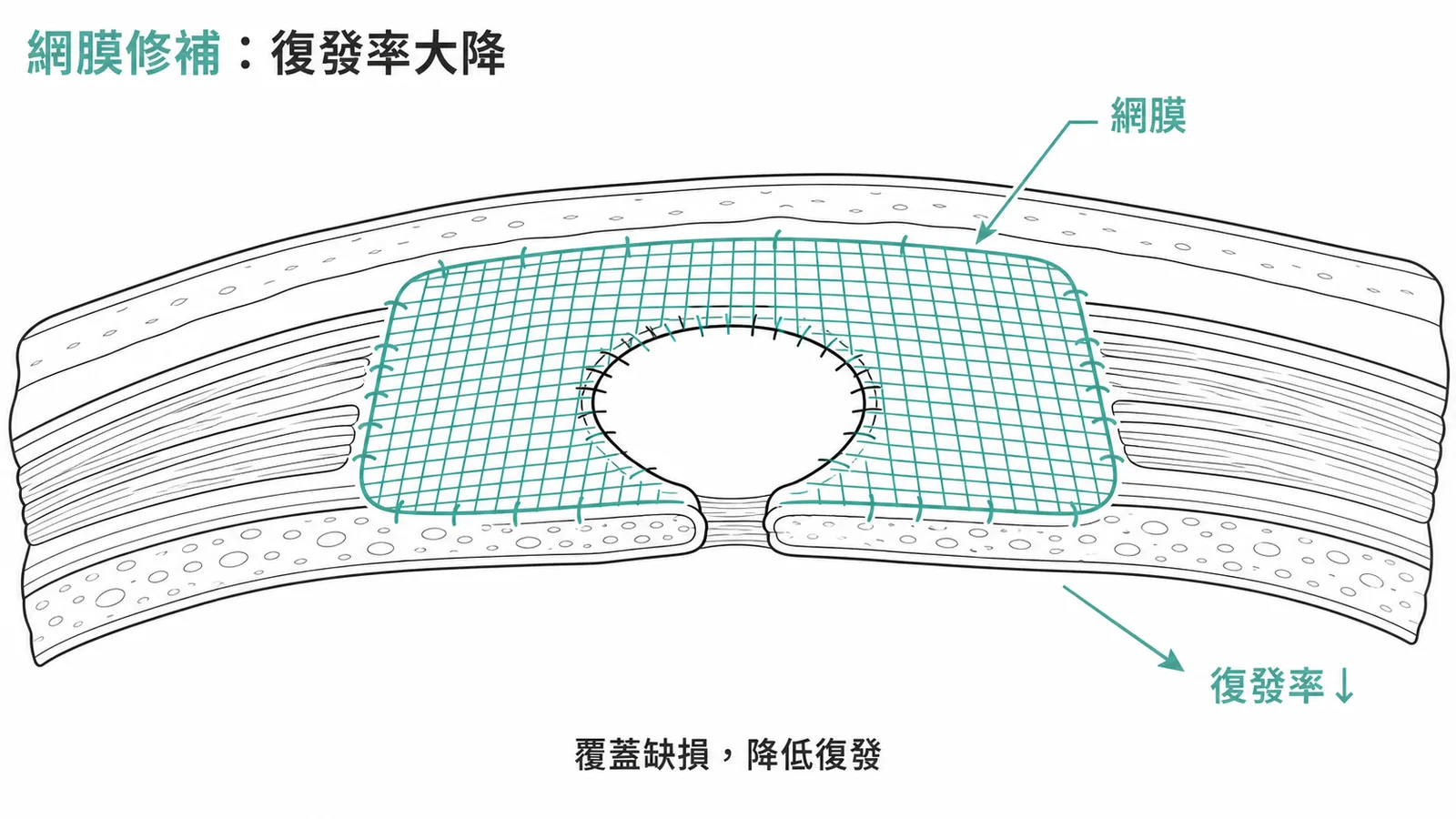 無張力網膜修補降低疝氣復發率示意圖