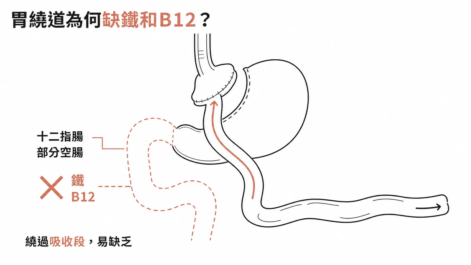 胃繞道術繞過十二指腸致鐵與B12吸收不良示意