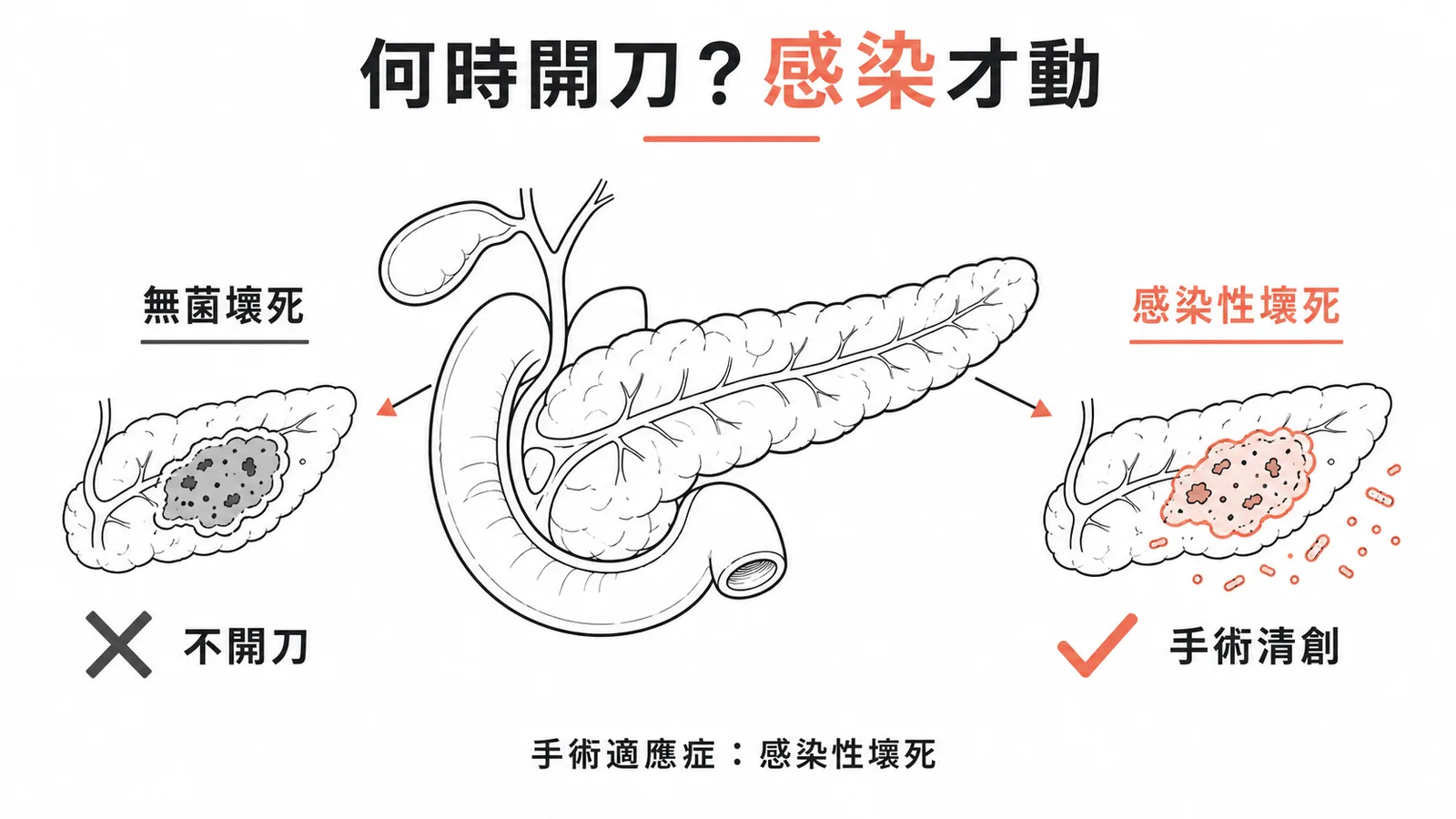 急性胰臟炎手術時機:感染性壞死才開刀