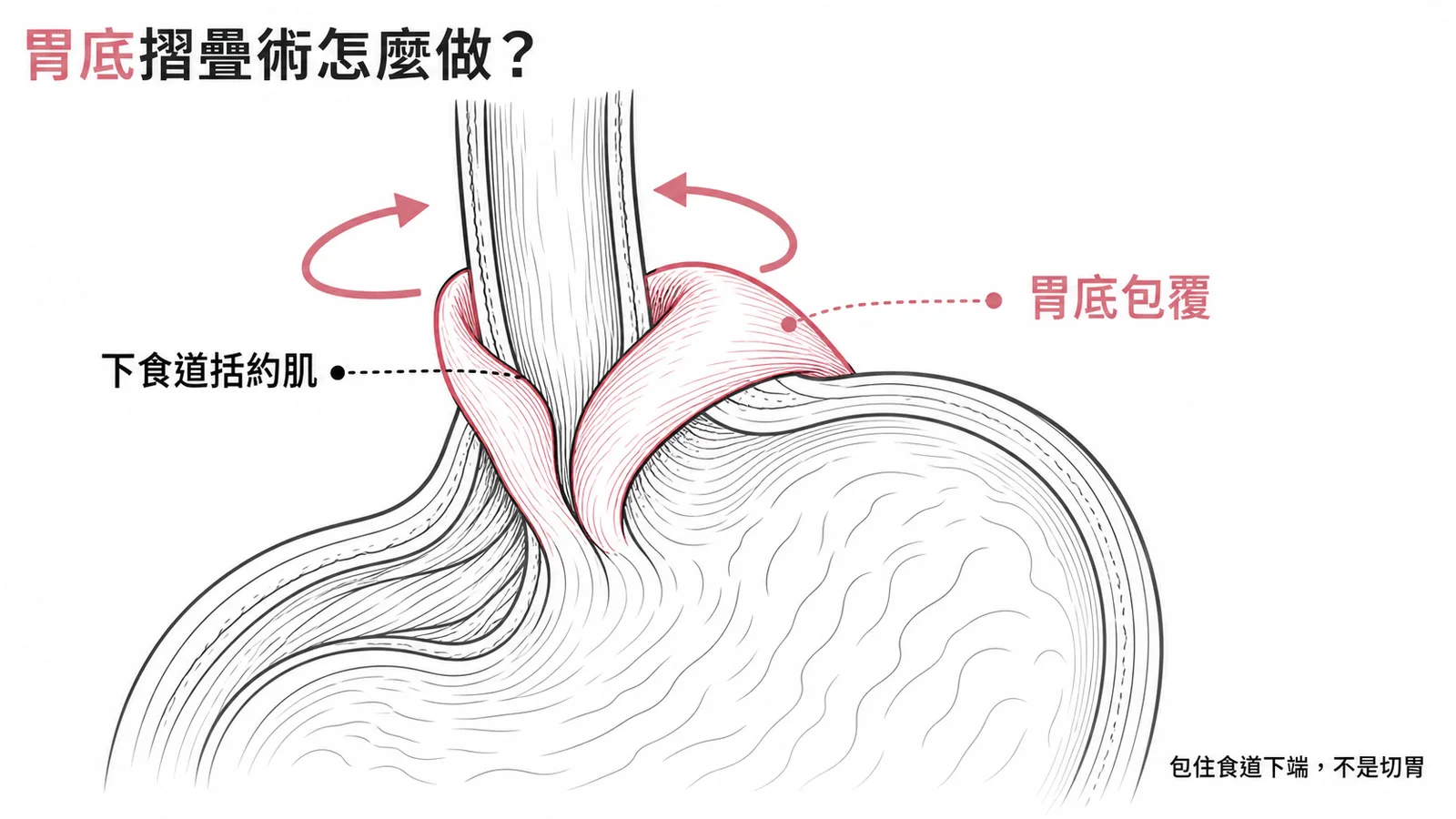 胃底摺疊術包覆下食道括約肌示意圖