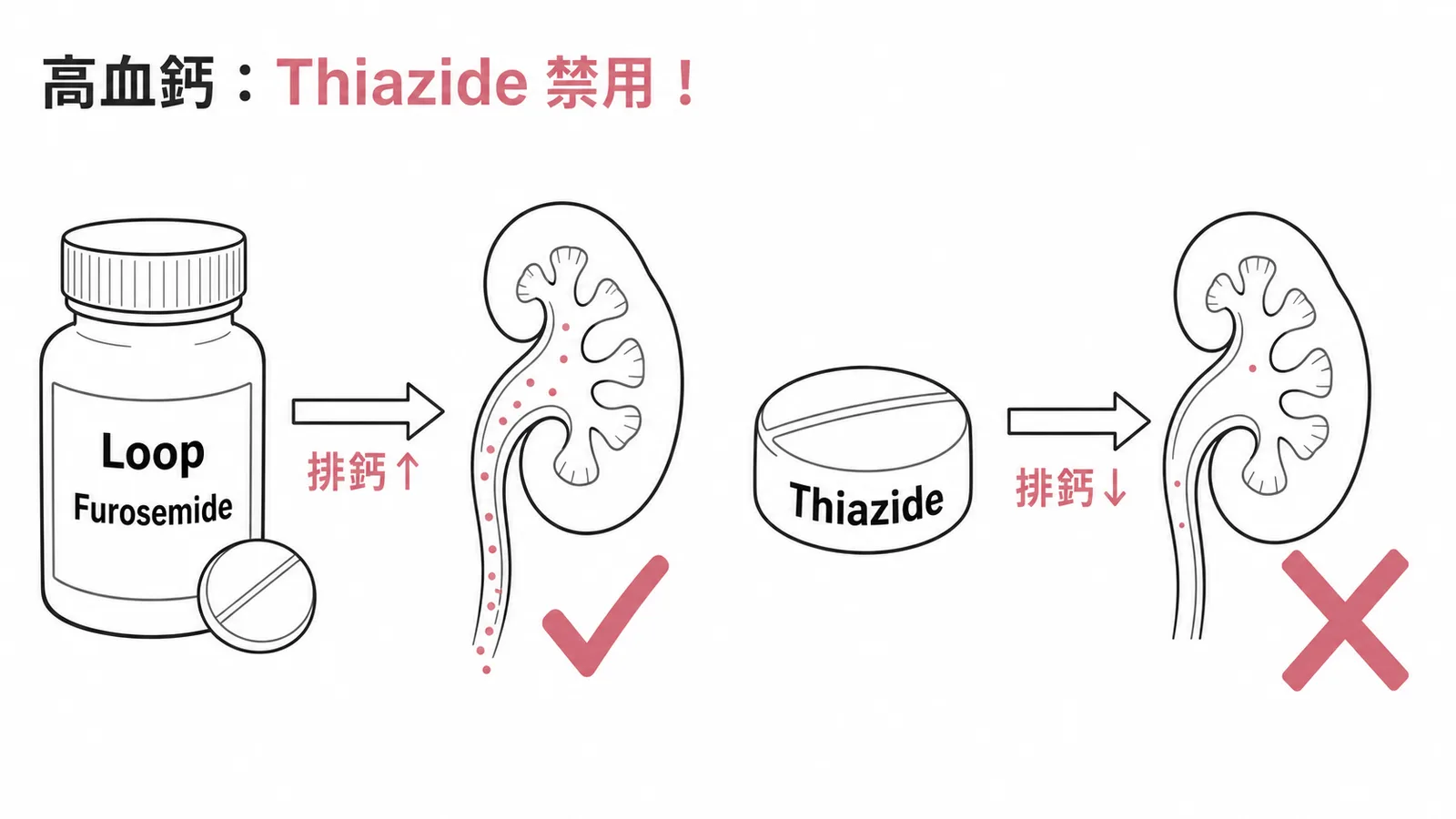 高血鈣治療利尿劑選擇:Loop可用、Thiazide禁用