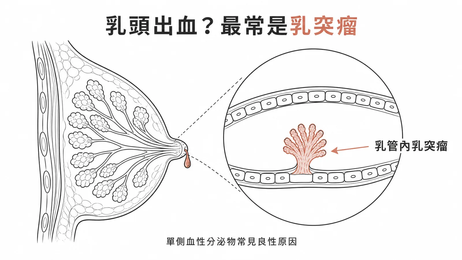 乳管內乳突瘤導致單側血性乳頭分泌物示意