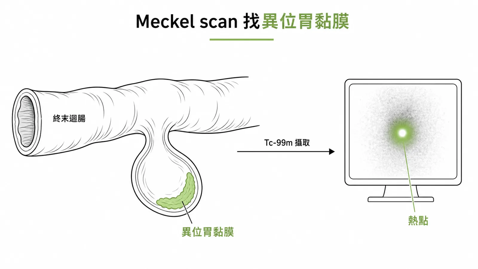 核醫 Tc-99m 掃描偵測梅克爾憩室異位胃黏膜示意圖