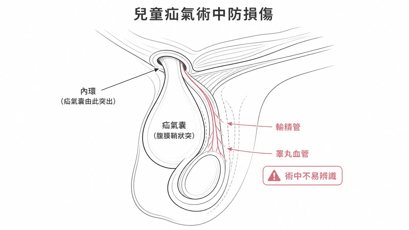 兒童間接型腹股溝疝氣手術需注意輸精管與睪丸血管損傷