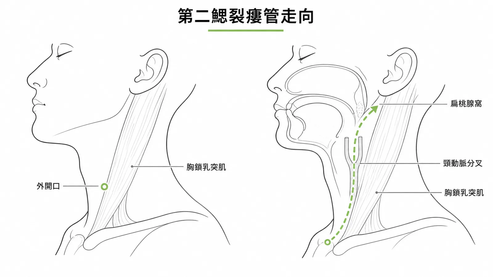 第二對鰓裂瘻管從下頸部向上延伸至扁桃腺窩的走行路徑