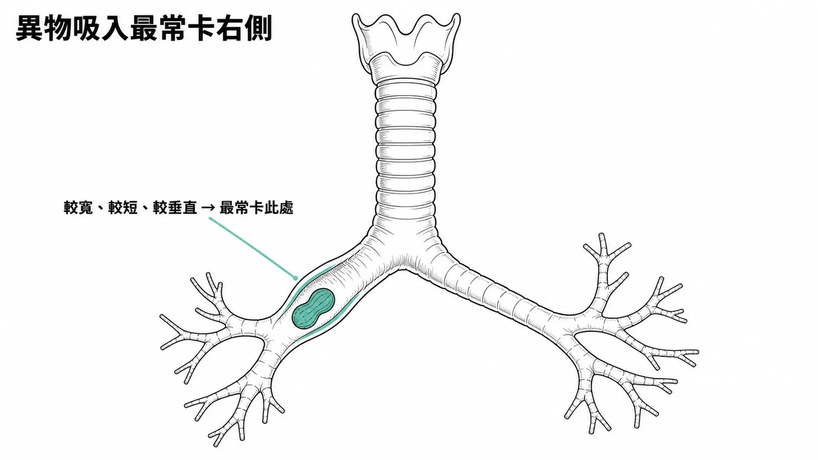 右主支氣管較寬短垂直故異物最常卡右側