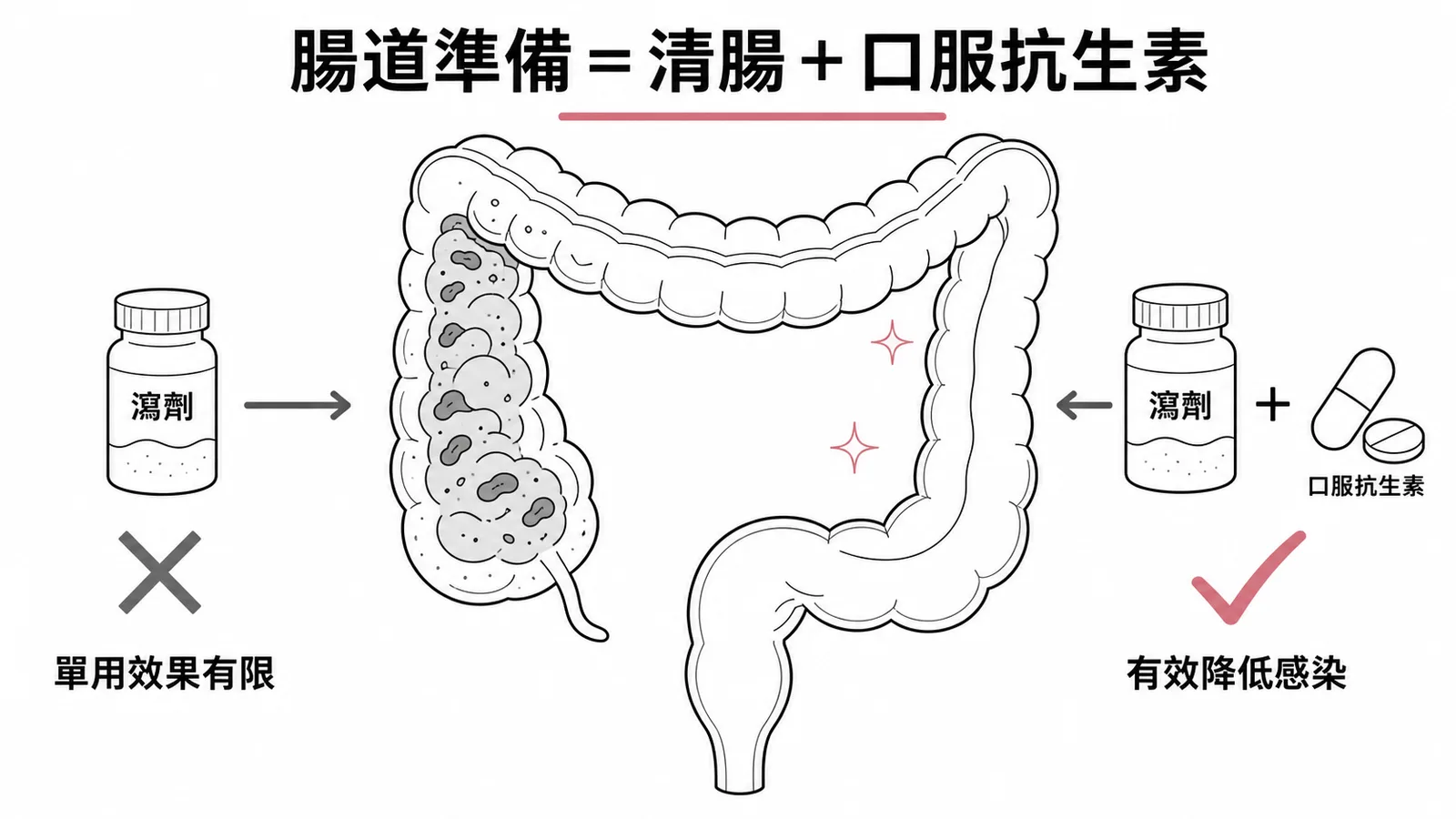 大腸直腸手術前機械性腸道準備結合口服抗生素降低感染風險