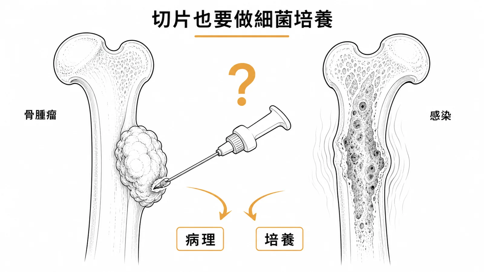 骨骼肌肉腫瘤切片時應同時做細菌培養以排除感染