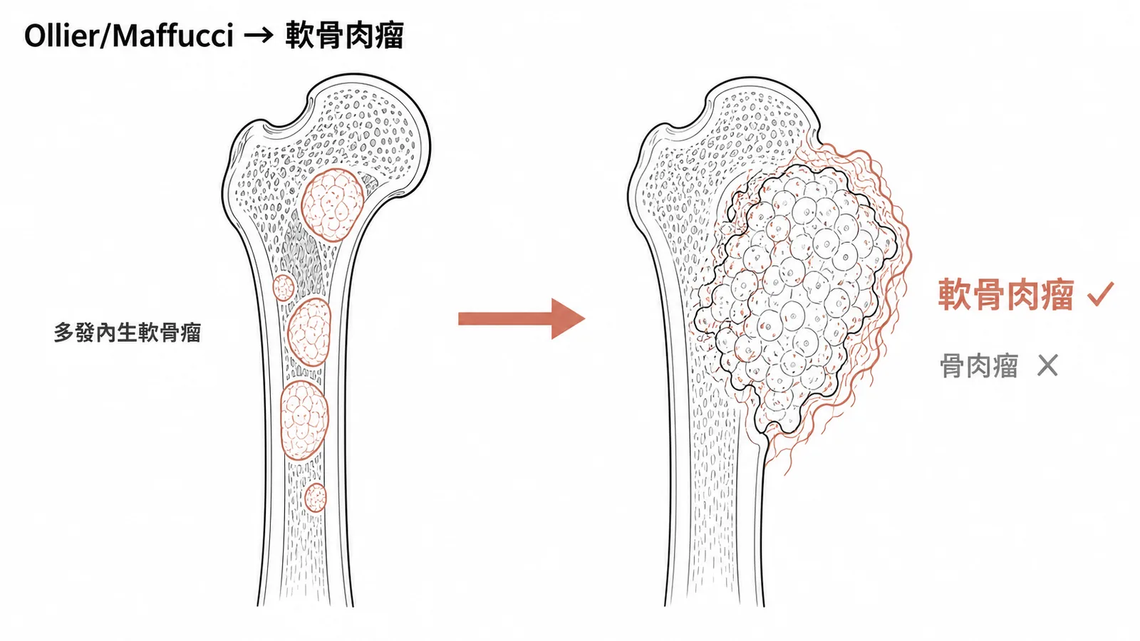 Ollier氏症與Maffucci症候群惡變為軟骨肉瘤而非骨肉瘤