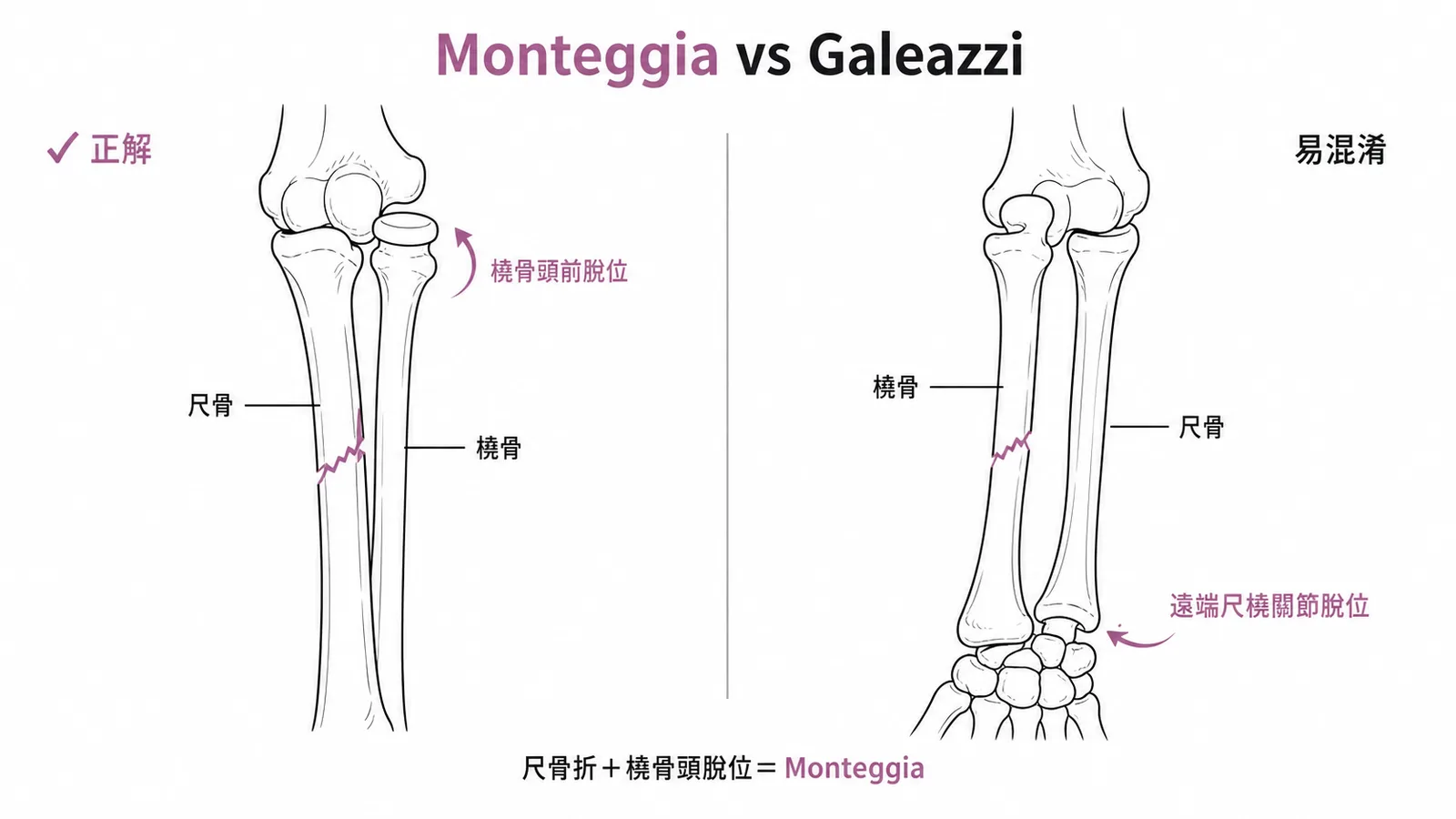 Monteggia骨折為尺骨骨折合併橈骨頭脫位示意圖