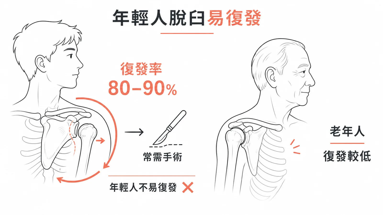 年輕人肩關節前向脫臼復發率高達80-90%示意圖