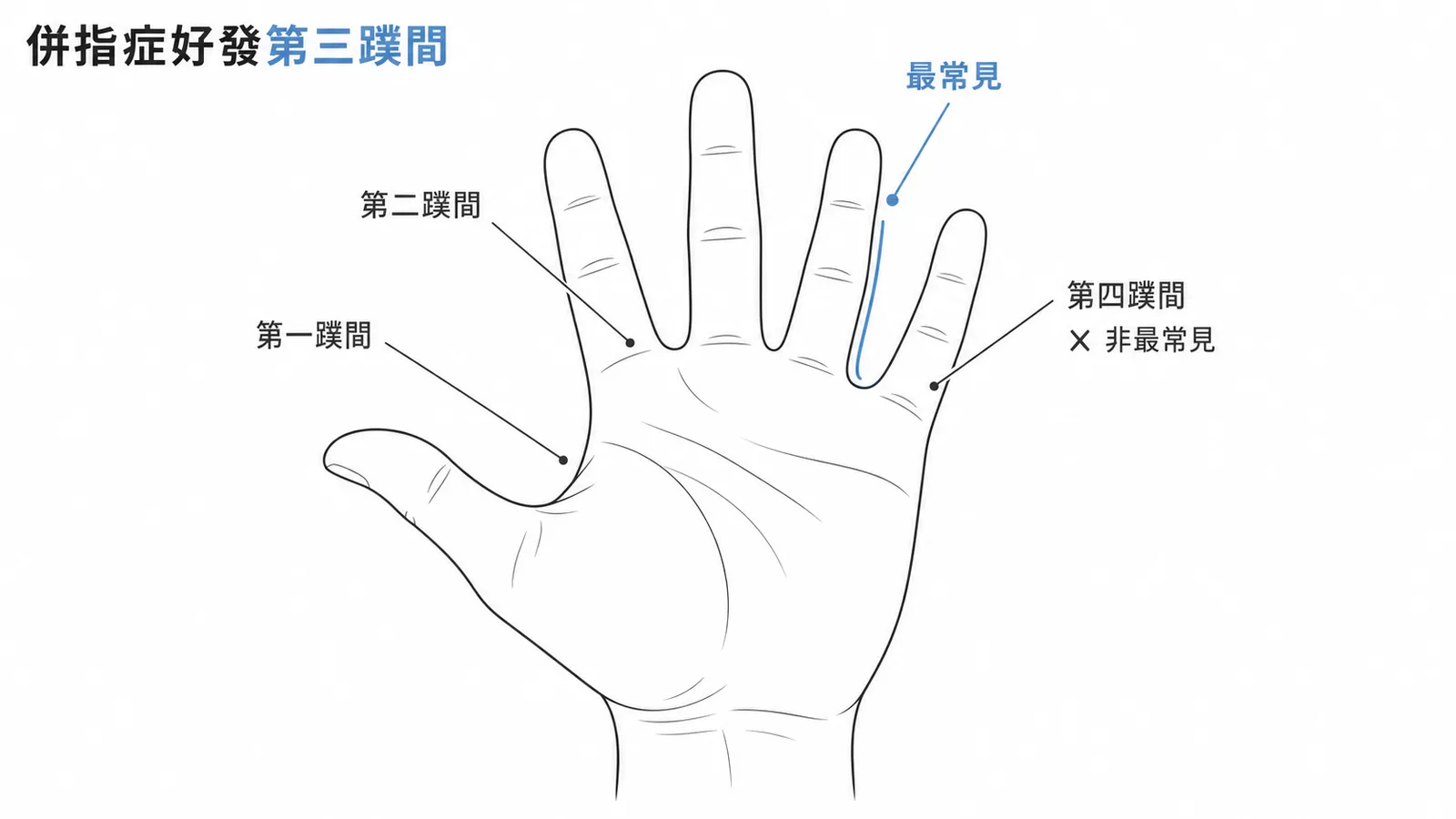 併指症最常發生在第三蹼間示意圖
