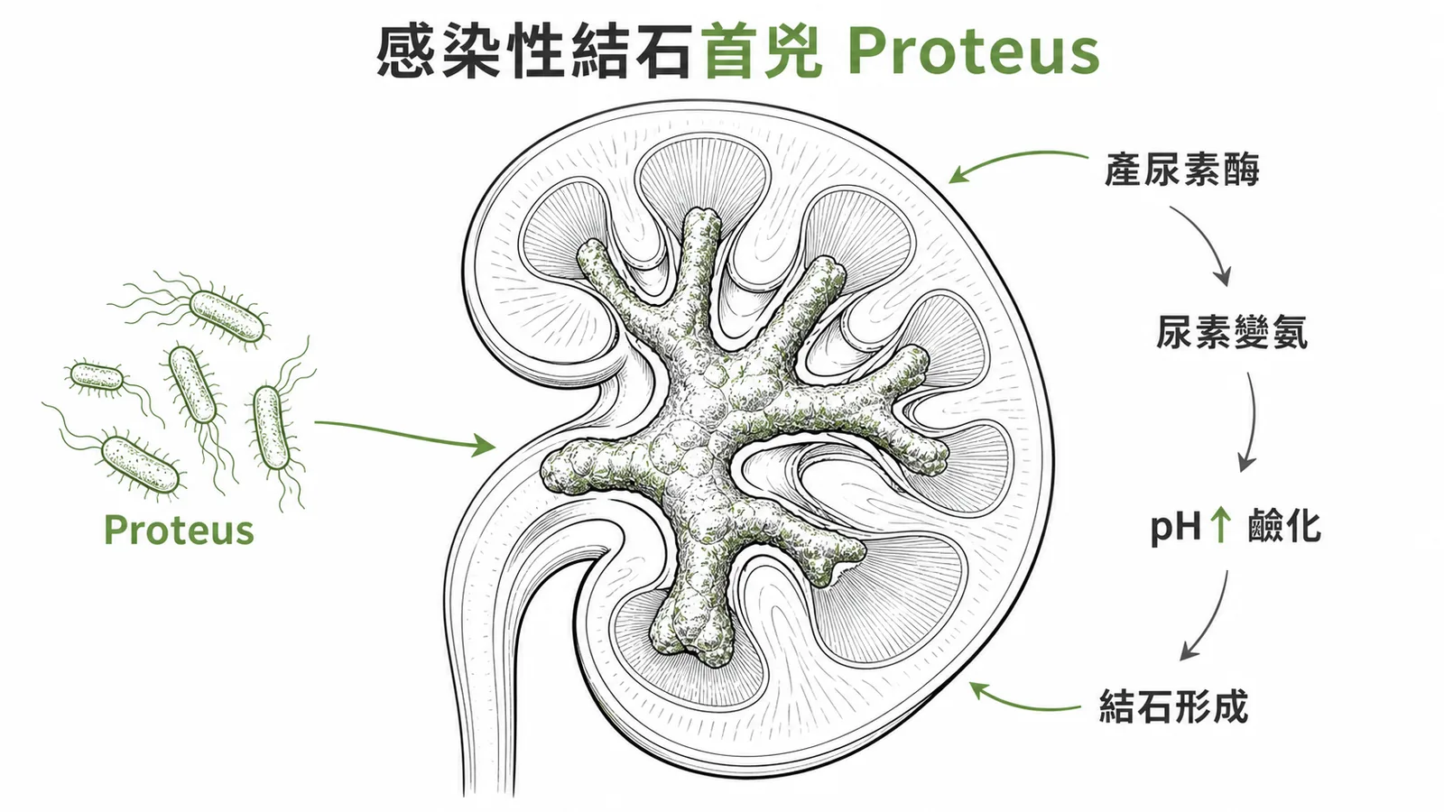 Proteus mirabilis產尿素酶使尿液鹼化形成感染性結石示意圖