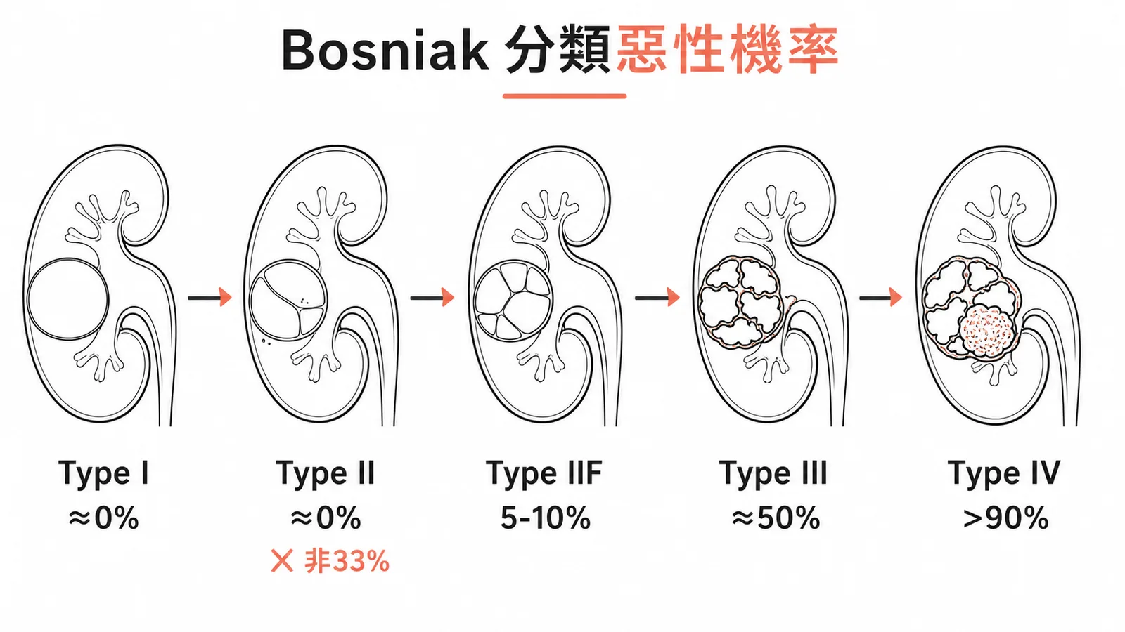 Bosniak腎臟囊泡分類I到IV型惡性機率示意圖