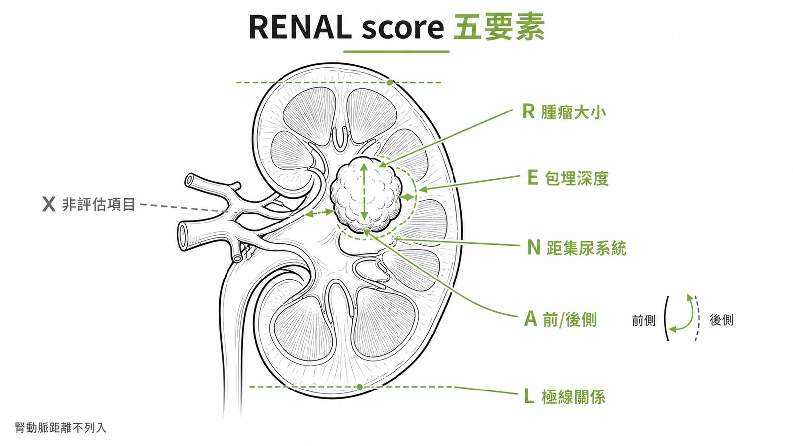 RENAL score五項評估項目不含腎動脈距離示意圖
