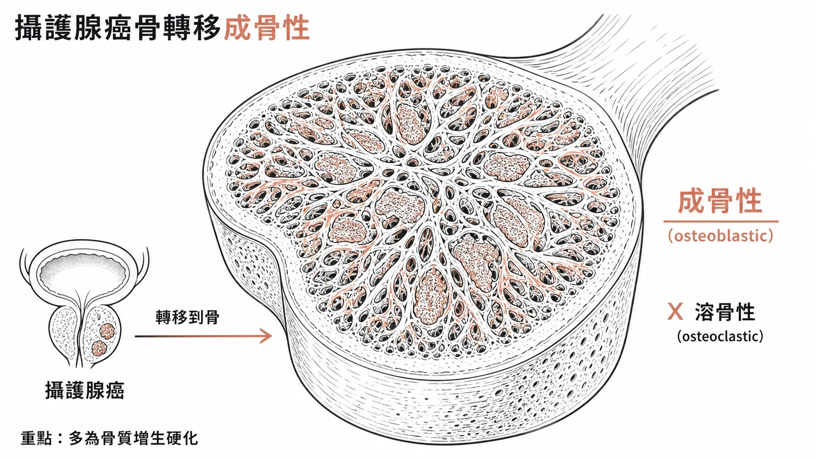 攝護腺癌骨轉移為成骨性非溶骨性病變示意圖