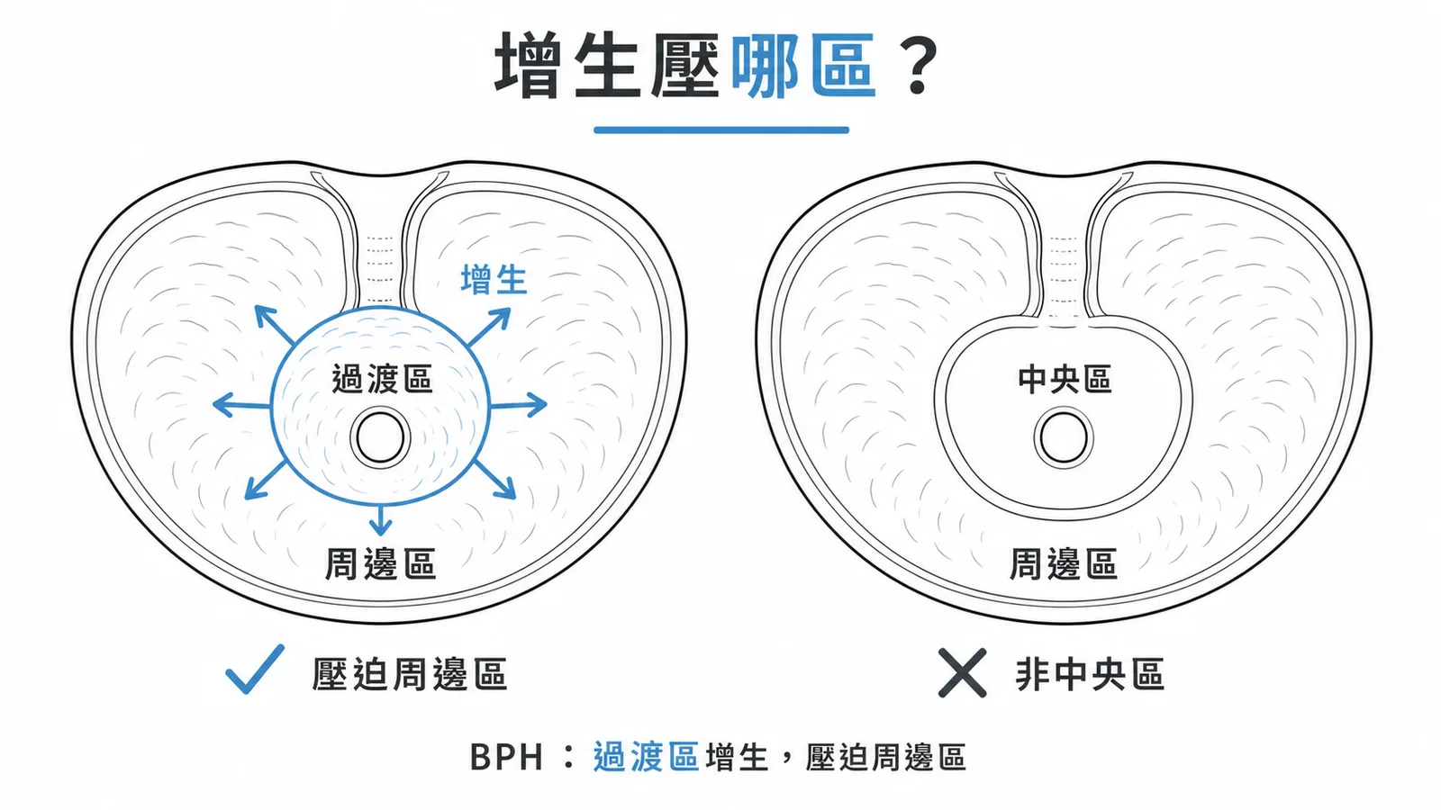 前列腺增生壓迫周邊區而非中央區