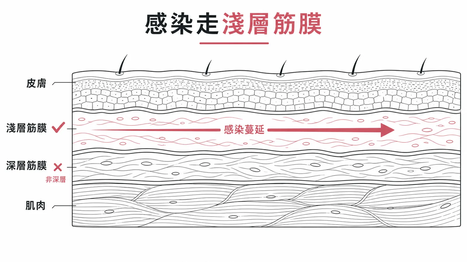 福尼爾壞疽沿淺層筋膜蔓延