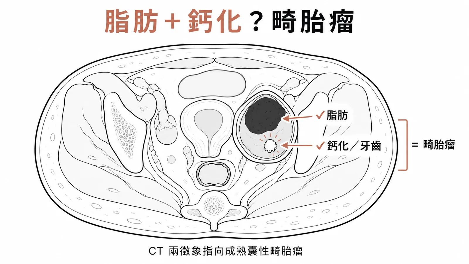 卵巢畸胎瘤CT特徵:脂肪加鈣化