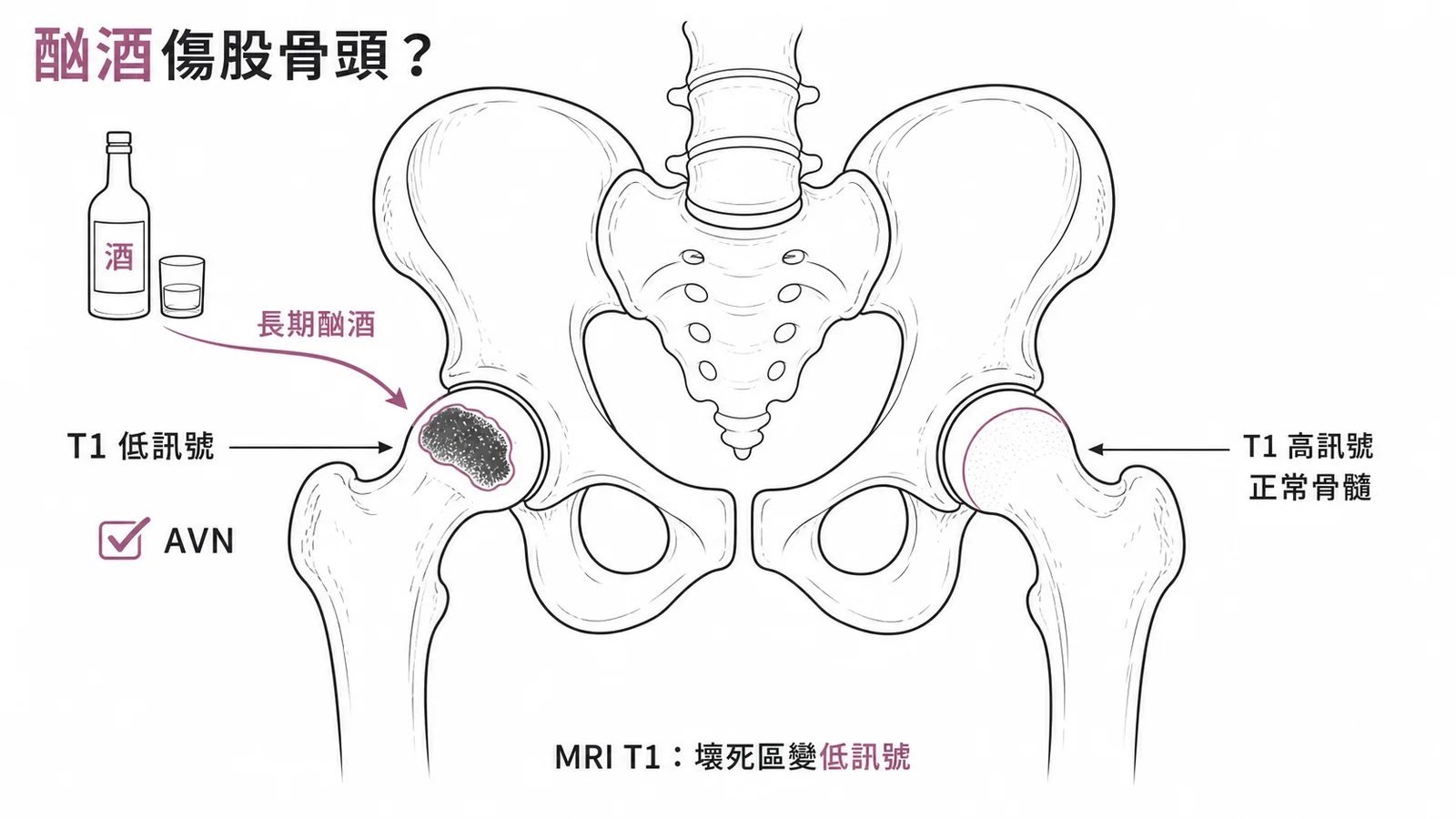 股骨頭缺血性壞死:MRI T1低訊號