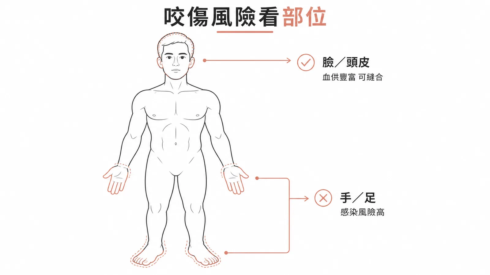 咬傷感染風險因部位而異