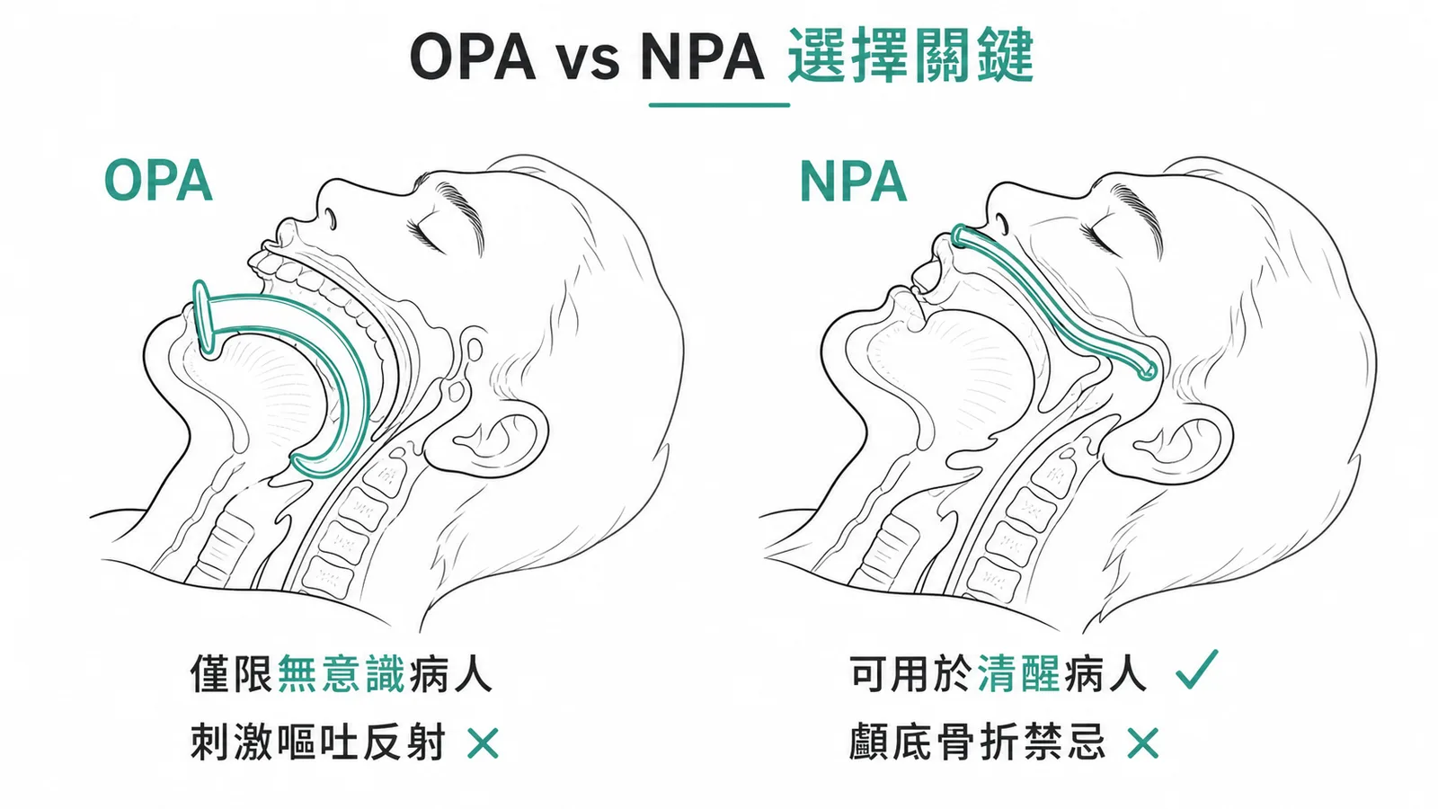OPA vs NPA 氣道選擇:OPA 僅限無意識病人、NPA 可用於清醒但禁忌顱底骨折