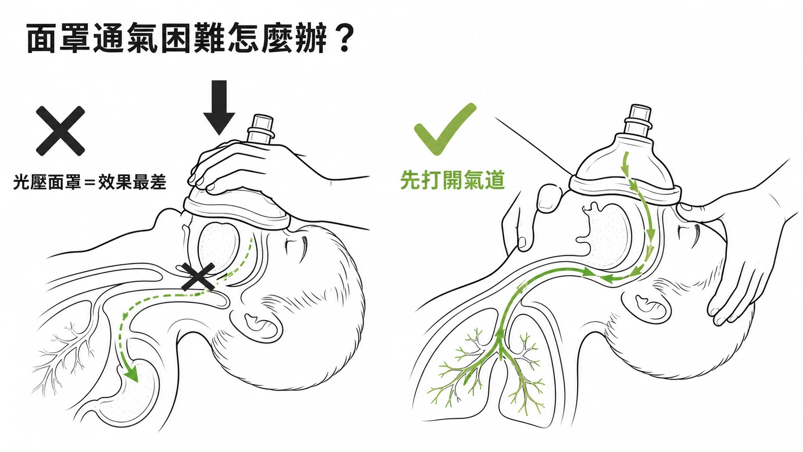 面罩通氣困難時應先打開氣道，光壓面罩效果最差