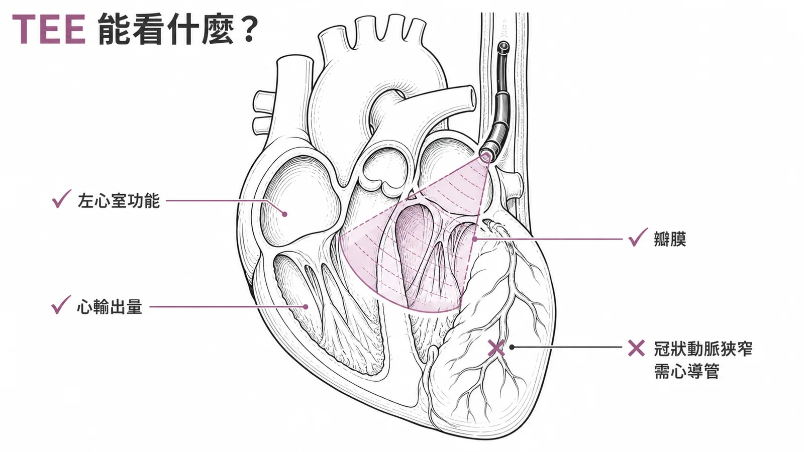 TEE 可評估心室功能、心輸出量、瓣膜，但無法評估冠狀動脈狹窄