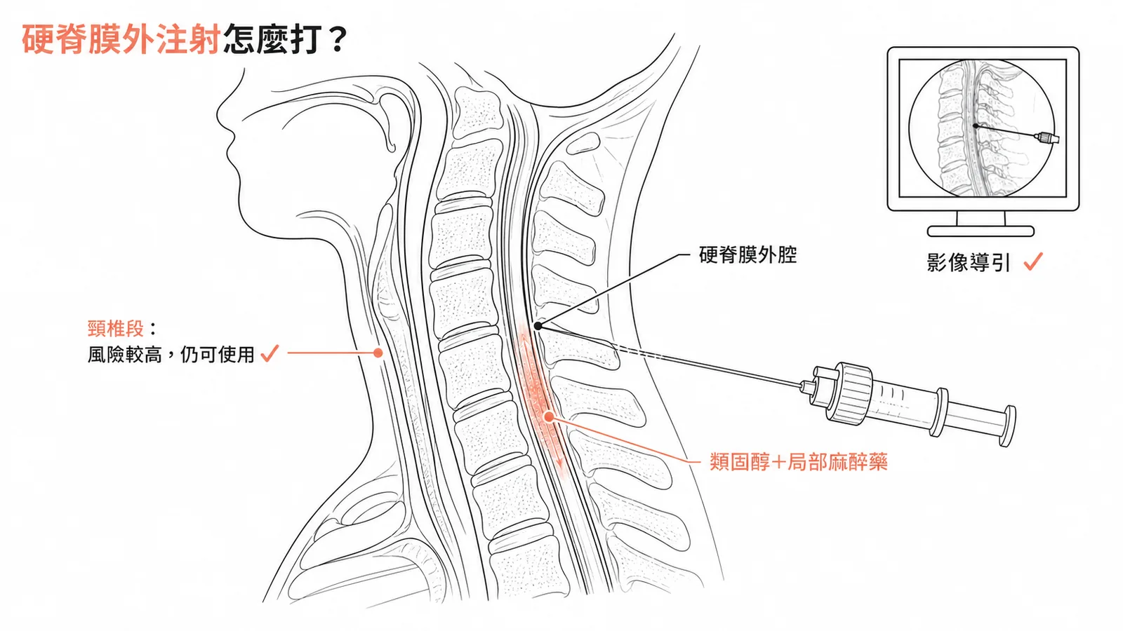 硬脊膜外注射：影像導引下注入類固醇加局麻藥，頸椎段風險較高但仍可使用