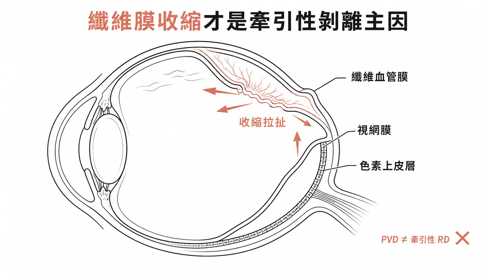纖維血管膜收縮拉扯視網膜造成牽引性剝離示意圖